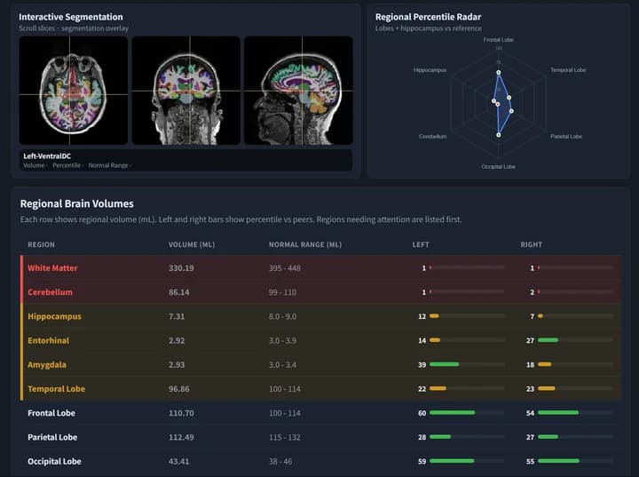 BrainDS dashboard with segmentation overlays in three planes, a regional percentile radar and a table of regional brain volumes with left and right percentiles