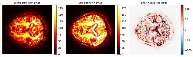 Temporal SNR maps of one mid-brain slice without and with the pad, and the difference map