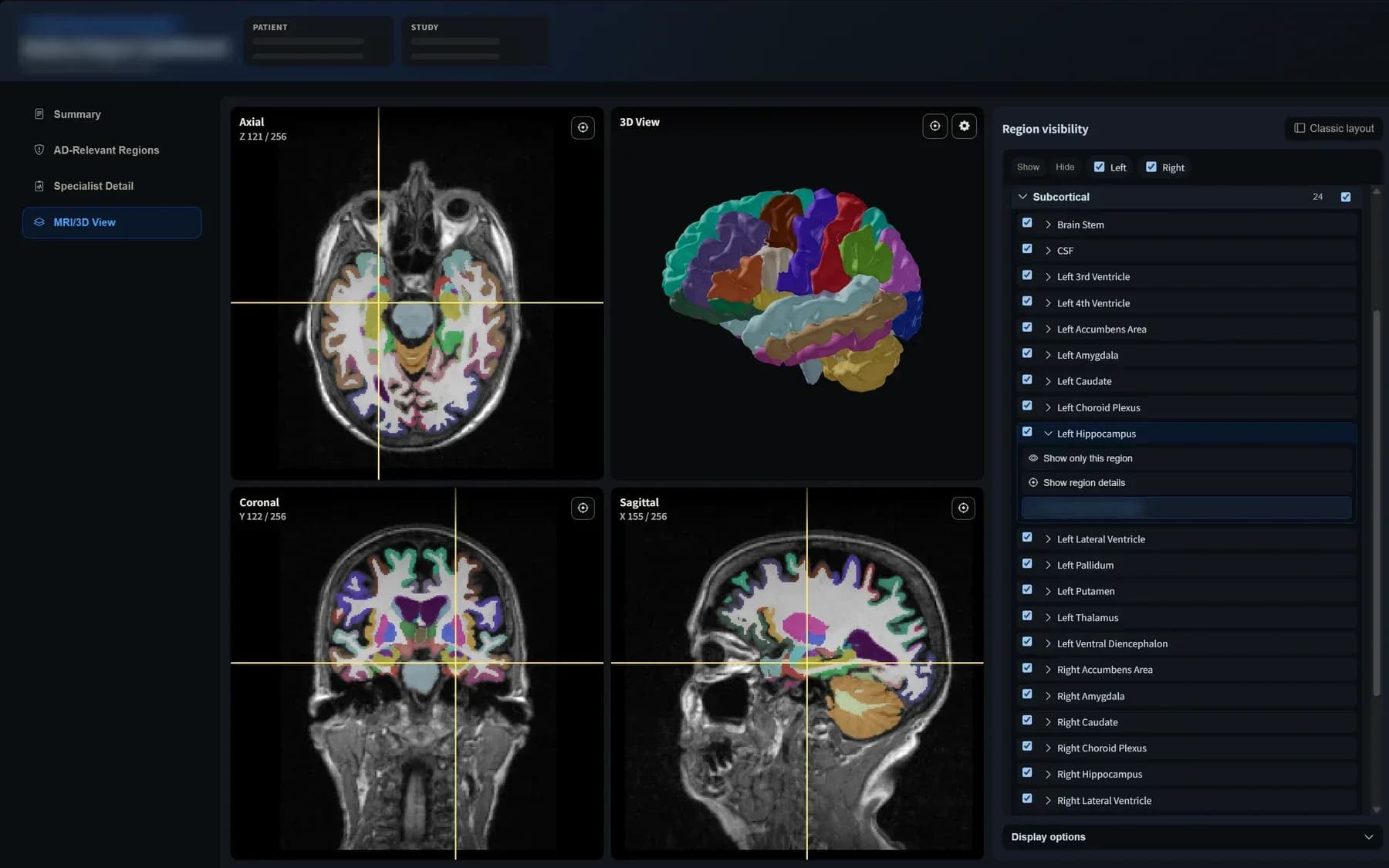 BrainDS MRI/3D view with a colour-coded brain segmentation in axial, coronal, sagittal and 3D panels, with patient details masked