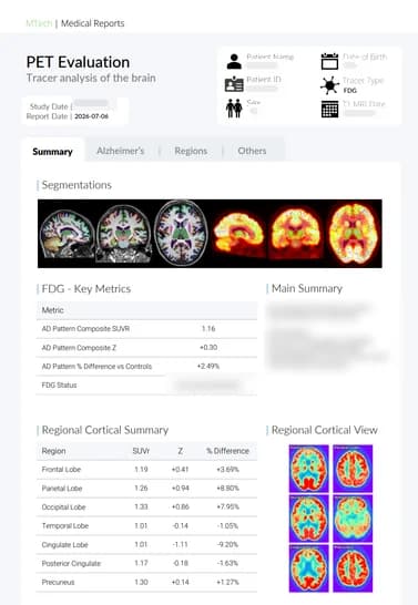 BrainDS + PET FDG report summary page with segmentations, key metrics and a regional cortical summary, with patient details masked