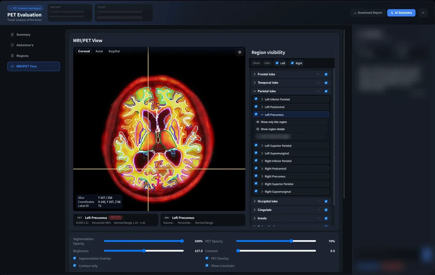 BrainDS + PET evaluation window with amyloid PET fused over MRI, region visibility and overlay controls, with patient details masked