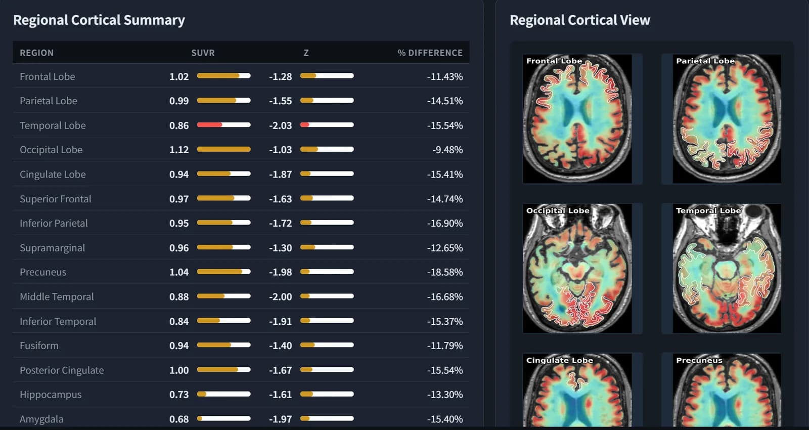 BrainDS + PET regional cortical summary table with SUVR, Z-score and percentage difference beside colour-mapped cortical views