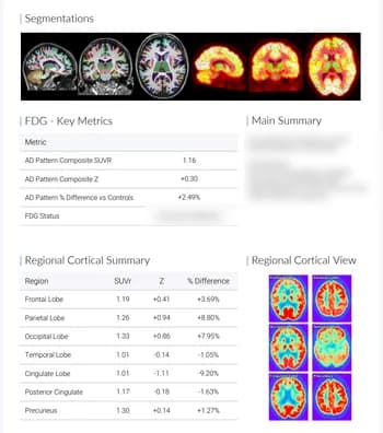 FDG summary page of the BrainDS + PET report with segmentations, key metrics and a regional cortical summary