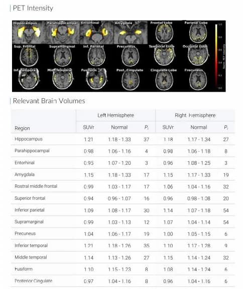 BrainDS + PET report page with regional PET intensity maps and a table of regional SUVR with reference ranges