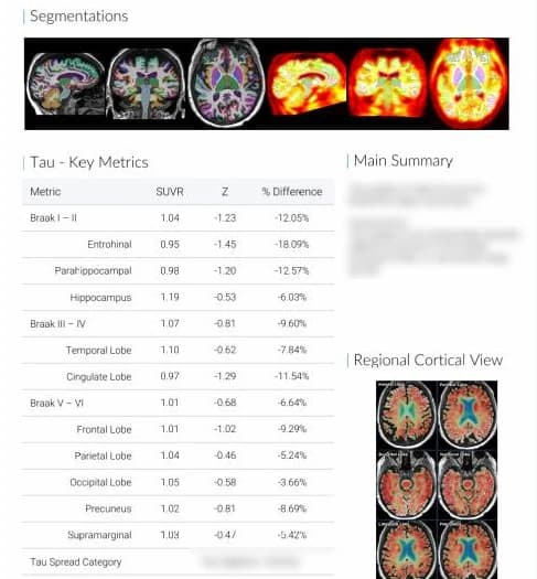 Tau summary page of the BrainDS + PET report with Braak-stage composite metrics and regional cortical views
