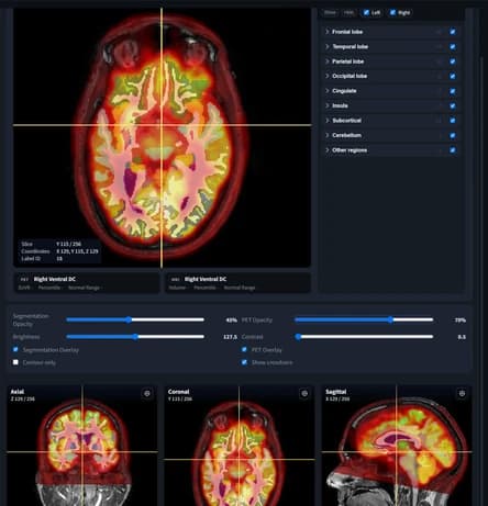 BrainDS + PET viewer with FDG PET fused over MRI, opacity, brightness and contrast controls, and axial, coronal and sagittal views