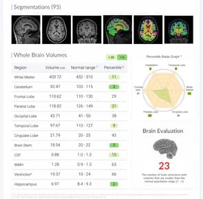 Summary page of the BrainDS structural report with segmentation thumbnails, a whole-brain volume table and a percentile radar