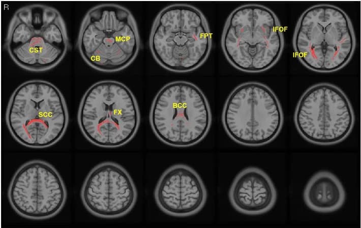 Axial MRI slices with red overlays marking white-matter tracts where diffusion signal increased with the dielectric pad