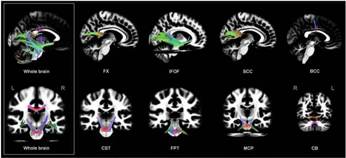 Three-dimensional tractography of the fibre tracts whose signal increased when the dielectric pad was used