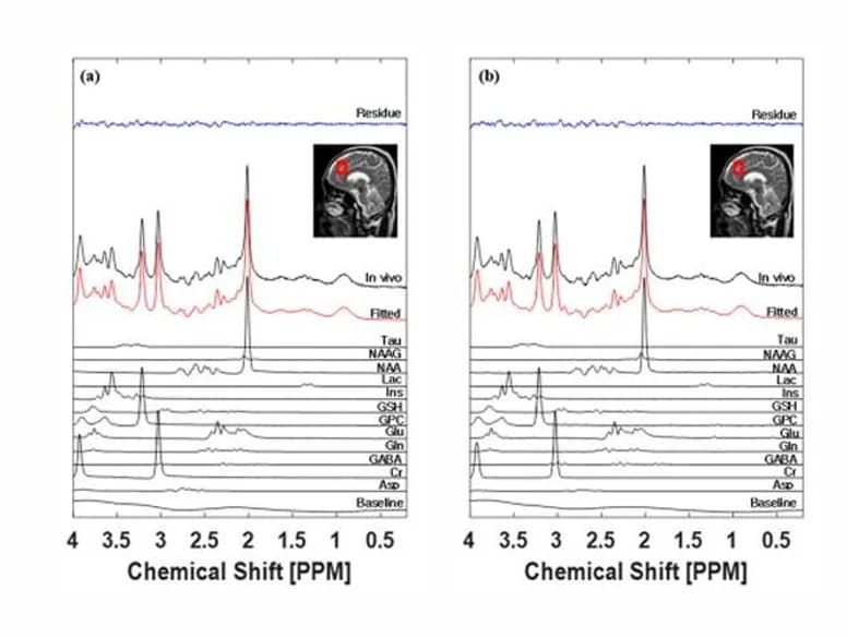 MR Spectroscopy — Metabolite spectrum analysis. Coming soon.