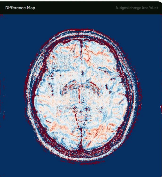 N2V MRI Denoising — Compare cleaner MRI slices in our live interactive N2V denoising demo.
