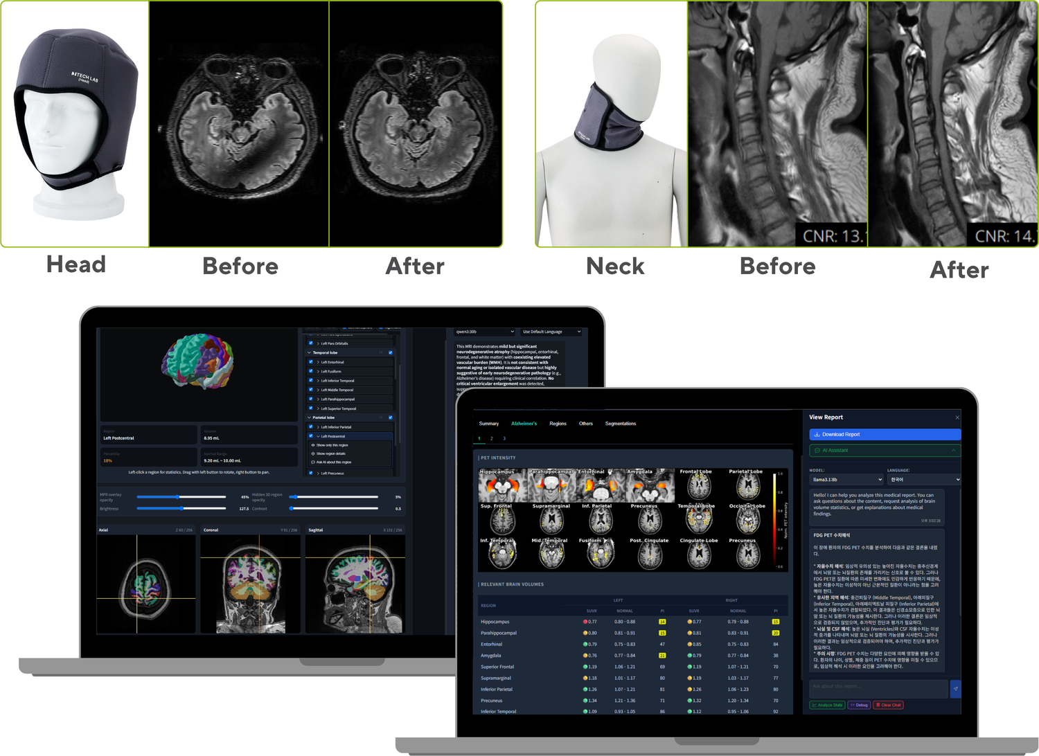 MTechLab MRI dielectric pads and AI brain-image analysis solution
