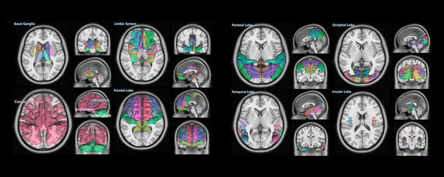 Brain segmentation